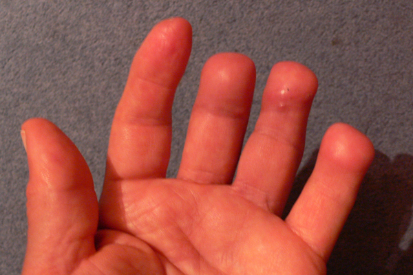 Frostbite Outcomes