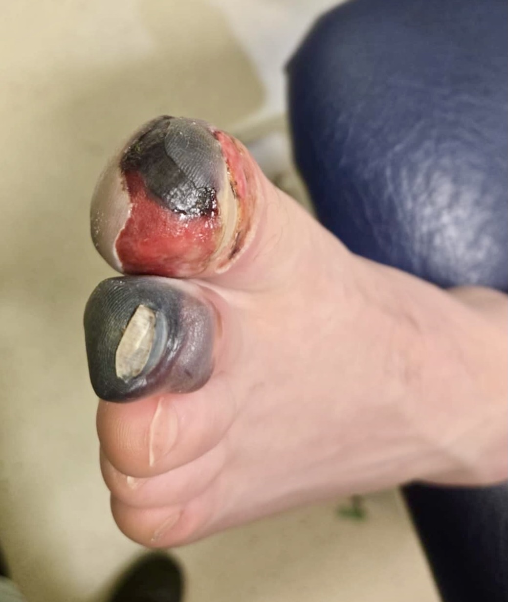 Day 12 - post debridement